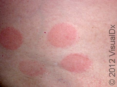 Contact dermatitis often has slightly elevated lesions with distinct borders.