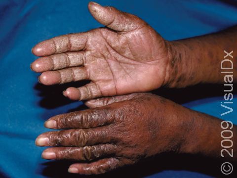 This is severe allergic contact dermatitis, resulting in very thick, scaly lesions on the fingers.
