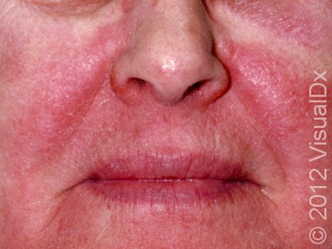 Redness and fine scale can be a sign of an allergic contact dermatitis.