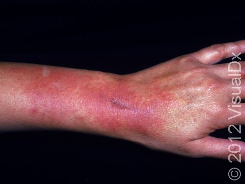 Allergic contact dermatitis often causes redness of the skin and itch.