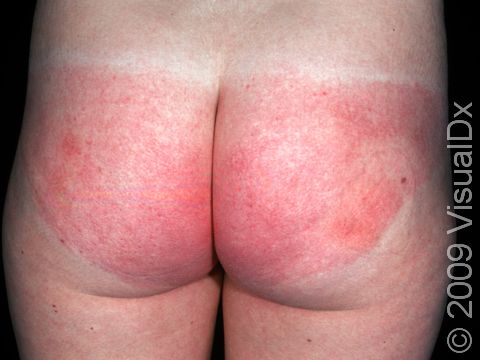 An allergy to a bathing suit frabic caused this rash.