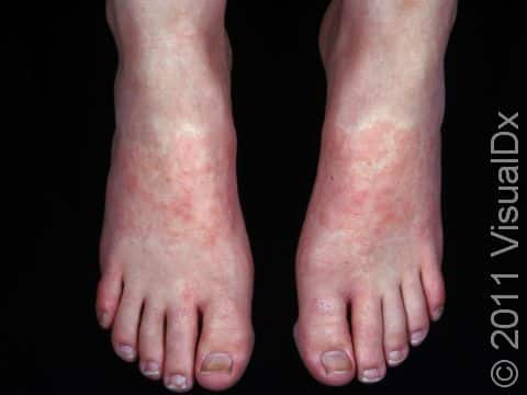 This person had an allergy to an ingredient in the sandals she was wearing. 