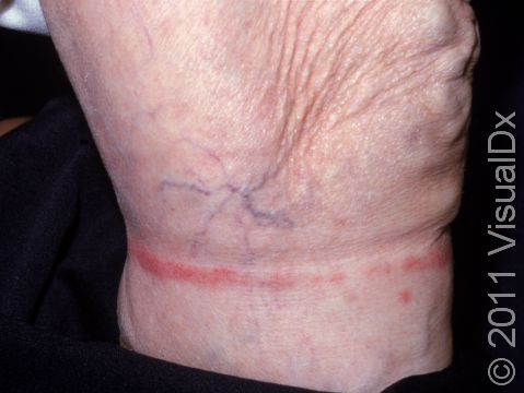 The well-demarcated line correlates with elastic in nylon stockings that caused this allergic reaction. 
