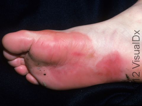 The sharp border of the redness on the foot is due to contact dermatitis from an allergy to a substance in contact with the skin.