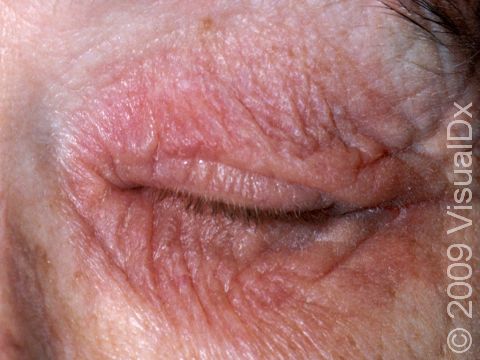 The thin eyelid skin is a frequent site for allergic contact dermatitis due to inadvertent touching the eyelids, transferring an allergen from the fingers to the lids.