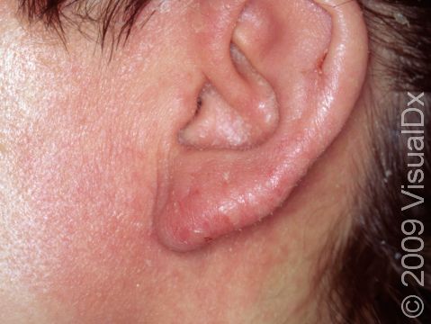 Allergic contact dermatitis to earrings is common.