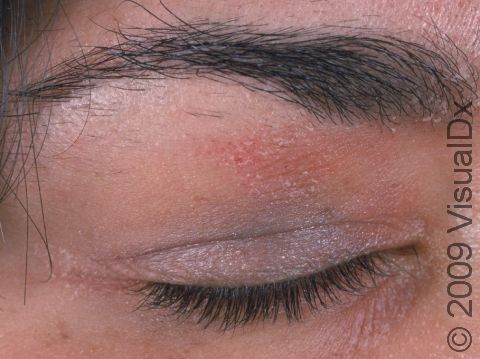 Nail polish allergy is often first seen at the eyelid.