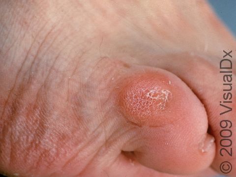 This image displays a corn on the top of a toe.