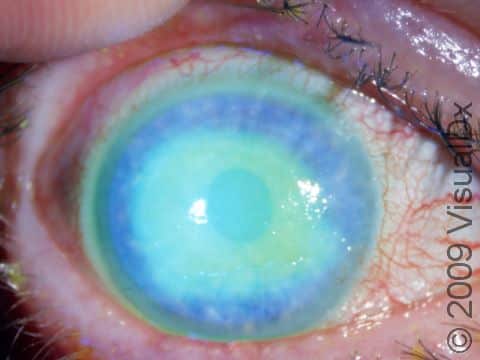 This large corneal abrasion can be seen with the naked eye, but fluorescent dye shows the full extent of involvement.