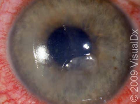 This classic abrasion demonstrates the typical ragged edge of a corneal abrasion.