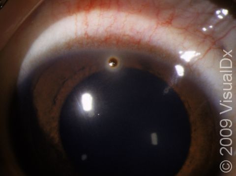 A small corneal foreign body, as displayed here, may not be seen without close inspection.