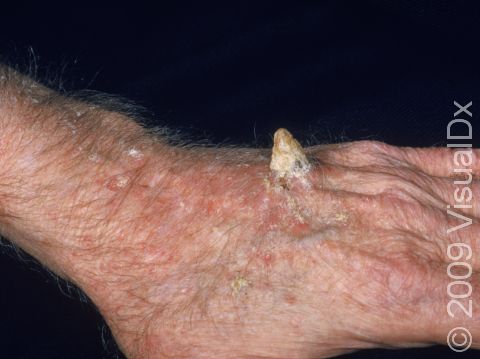 Cutaneous horns typically occur on sun-exposed body parts, as displayed in this image.