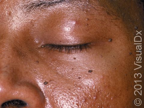 In dermatosis papulosa nigra, tiny to small, dark brown elevations of the skin are typically located on or around the cheeks.