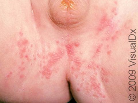 Scattered papules and pustules are typical in a diaper area candida infection (yeast infection).