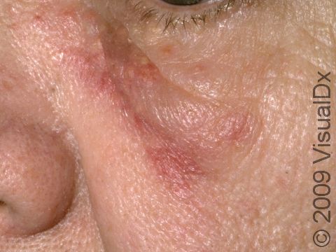 Circular dull red spots that persist on the face are often the first sign of discoid lupus.