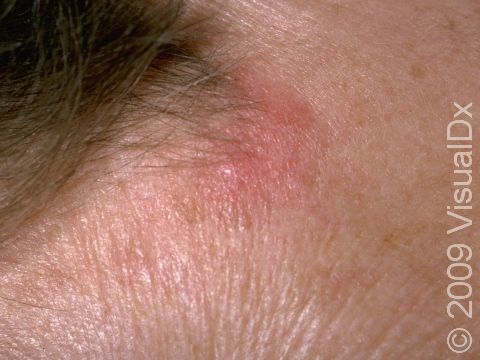 This image displays a red, slightly raised lesions typical of early discoid lupus erythematosus.