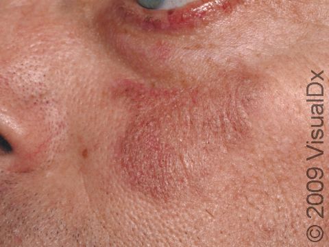Discoid lupus erythematosus can have slightly elevated pink or red lesions.