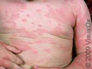 Pediatric Drug Eruption: Symptoms, Treatment, and Prevention