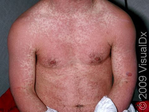 This image displays a widespread measles-like eruption, typical in allergic reactions to medications.