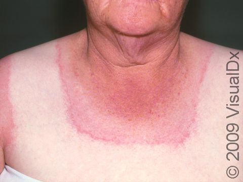 This image displays a reaction from exposure to sunlight caused by an interaction with a medication used for high blood pressure.