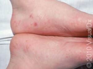 Tapioca Like Rash Dyshidrotic Eczema Condition, Treatments and Pictures for Teens - Skinsight