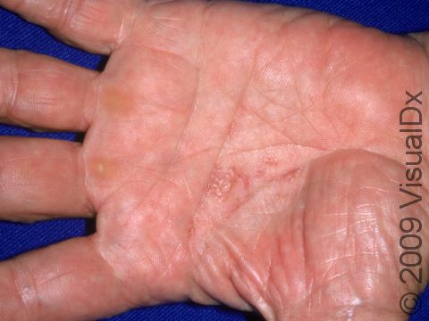 This image displays the rather unusual location of dyshidrotic dermatitis on the palms.