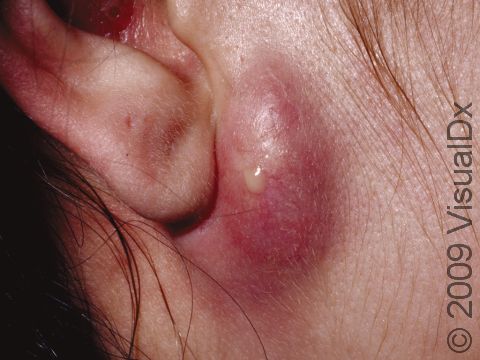 This image displays a large, infected cyst, which is draining some pus.