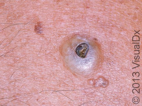 This image displays a cyst that has opened to the surface over time, turning a dark brown and appearing as a 