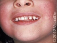 Fifth Disease (Erythema Infectiosum) – Child