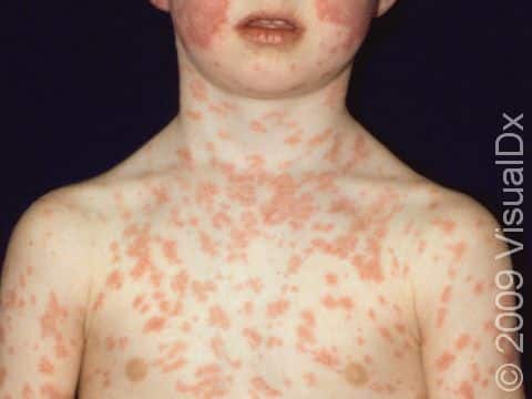 Fifth disease causes a rash on the cheeks and a more widespread rash that typically involves the trunk and arms.