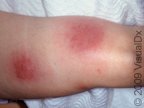 This image displays red, warm, tender lesions typical of erythema nodosum.