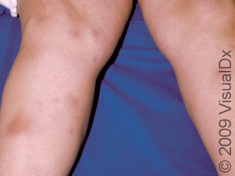 Tender, deep lesions are typically found on the legs in patients with erythema nodosum.