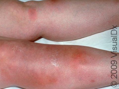 This image displays the typical presentation of erythema nodosum on the legs with scattered, red, slightly elevated lesions.