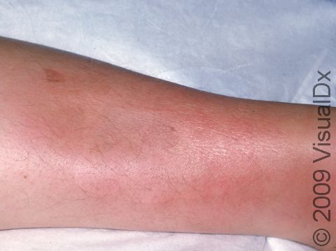 In erythema nodosum, the areas of skin involved are often red and warm to touch.