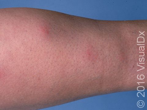 This image displays multiple red lesions on a leg, typical of erythema nodosum.