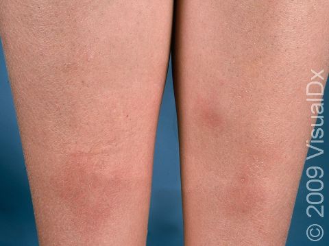 This image displays the red, elevated areas of the skin on the lower legs, typical of erythema nodosum.