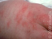 Erythema Toxicum Neonatorum – Infant