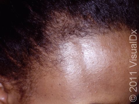 Unlike male pattern baldness, total hair loss is unusual in female pattern hair loss. There is often only subtle thinning present with preservation of the hairline, as seen here.