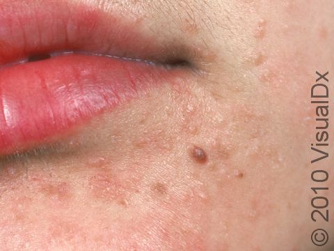 This image displays flat warts on the face, which can be skin-colored to slightly pink.