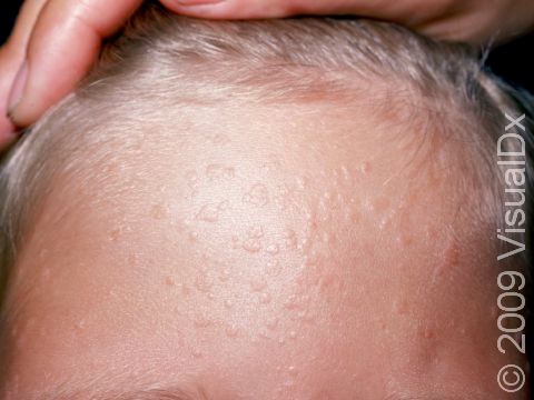 Numerous skin-colored flat warts are seen here on the forehead.