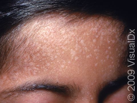 In people with darker skin colors, flat warts can look lighter in color than normal skin.