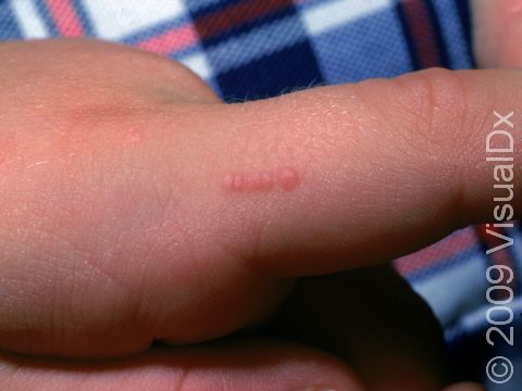 In lighter skin colors, flat warts are pink in color. The straight line of warts displays the spread of the virus from a scratch.