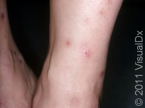 Flea Bite Condition Treatments and Pictures for Adults Skinsight