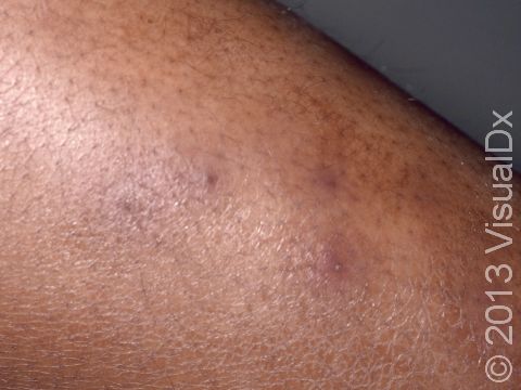 This image displays a close-up of folliculitis with one of the lesions being pus-filled.