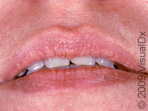 This image displays small yellow bumps on the oil glands of the upper lip typical of Fordyce spots.