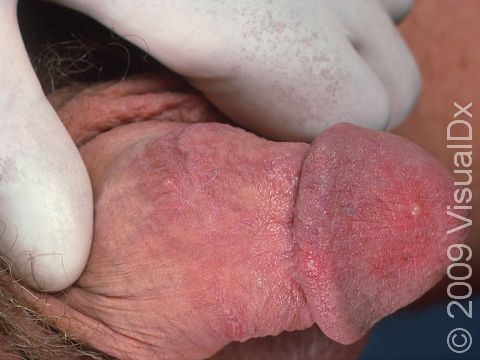 Patients with herpes simplex of the genitals typically experience early symptoms of itching and/or burning of the skin, and then blisters develop over days, which crust, scab, and resolve in about two weeks.