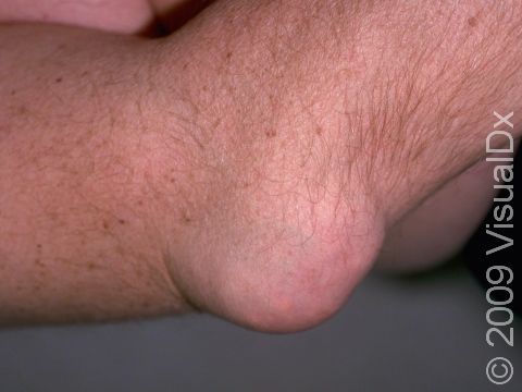 Gout often results in nodules called tophi; this image shows an affected elbow.