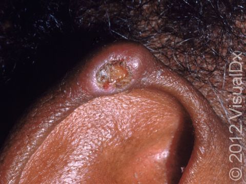 The rim of this man's ear has an ulcer due to a gouty tophus.
