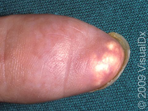 This image displays yellow-white nodules under the skin, typical of gout.