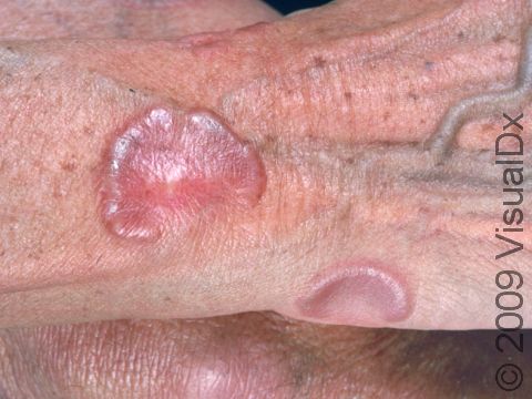 This image displays lesions that are raised at the edge and depressed in the center, typical of granuloma annulare.
